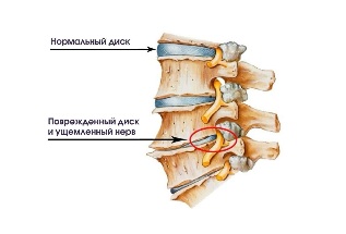 Симптоми на грлото на дегенеративни диск болест